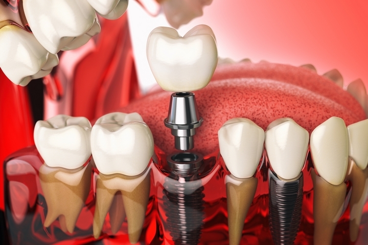 5 Essential Steps to Take Care of Your Dental Implants
